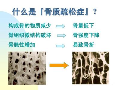 骨质疏松非小事，重视预防是关键！